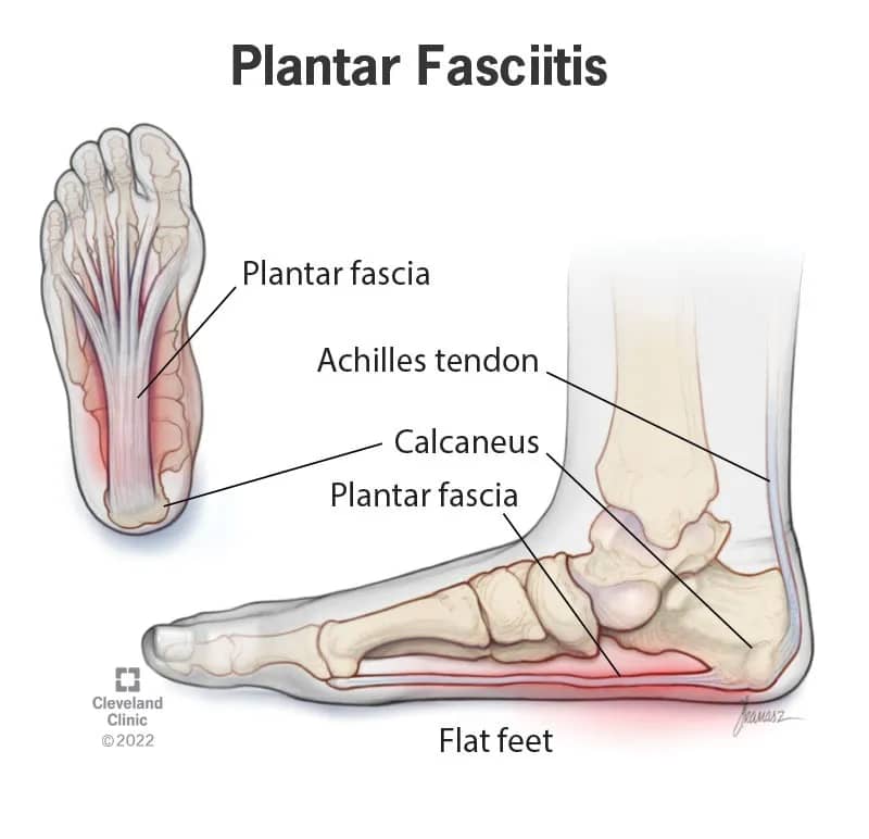 Plantar Fasciitis Effective Treatment Options